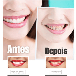 SmileKit – Clareamento total em 30 minutos
