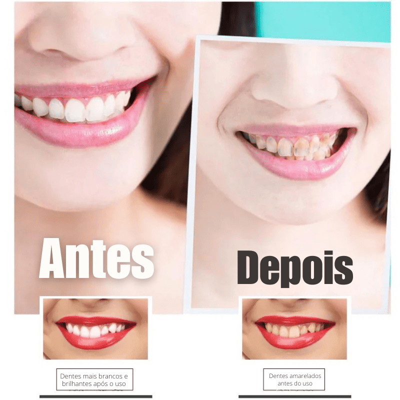 SmileKit – Clareamento total em 30 minutos