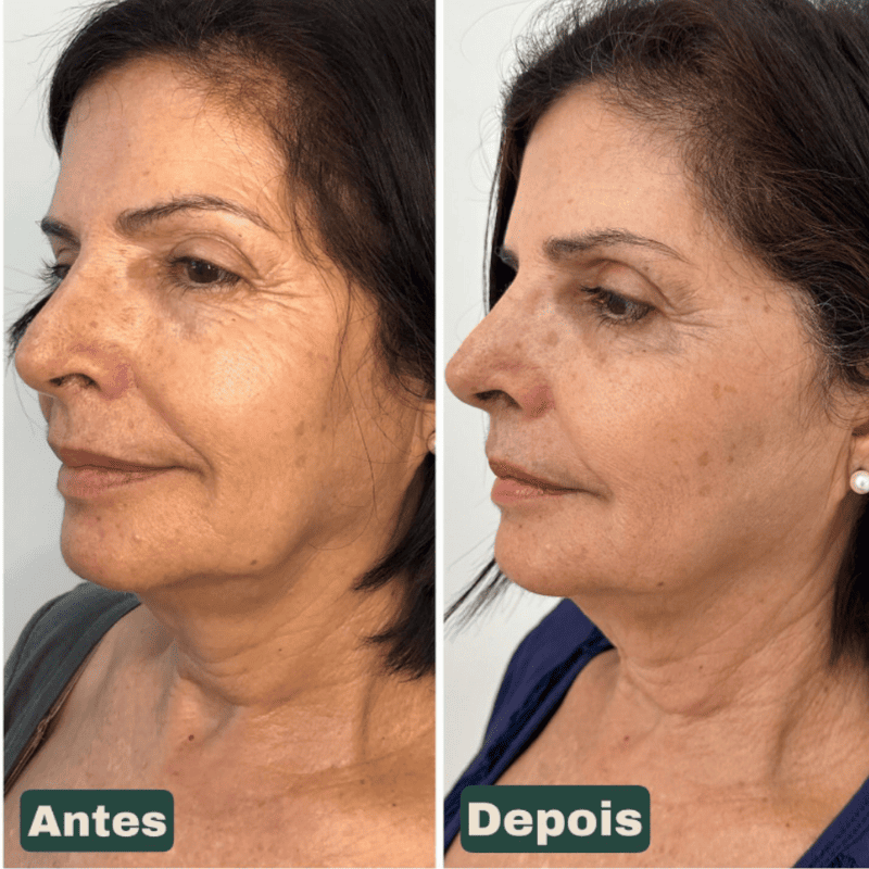 CollageSkin – Máscara Anti-idade com Efeito Lifting