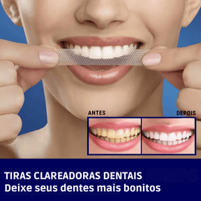SmileKit – Clareamento total em 30 minutos